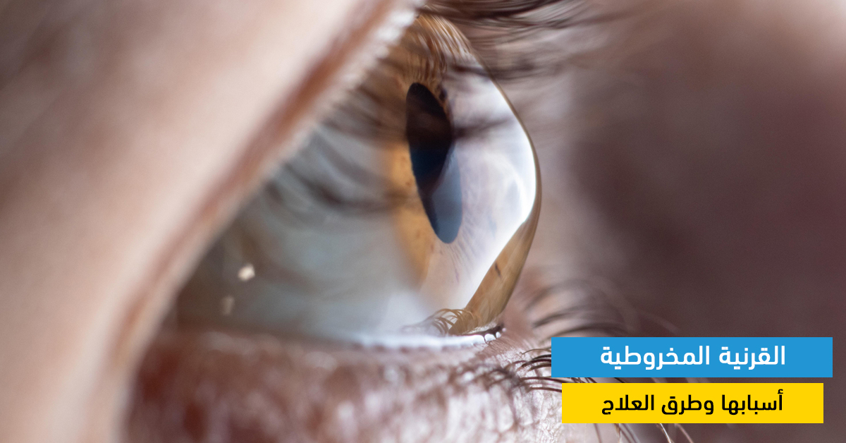 القرنية المخروطية: أسبابها وطرق العلاج