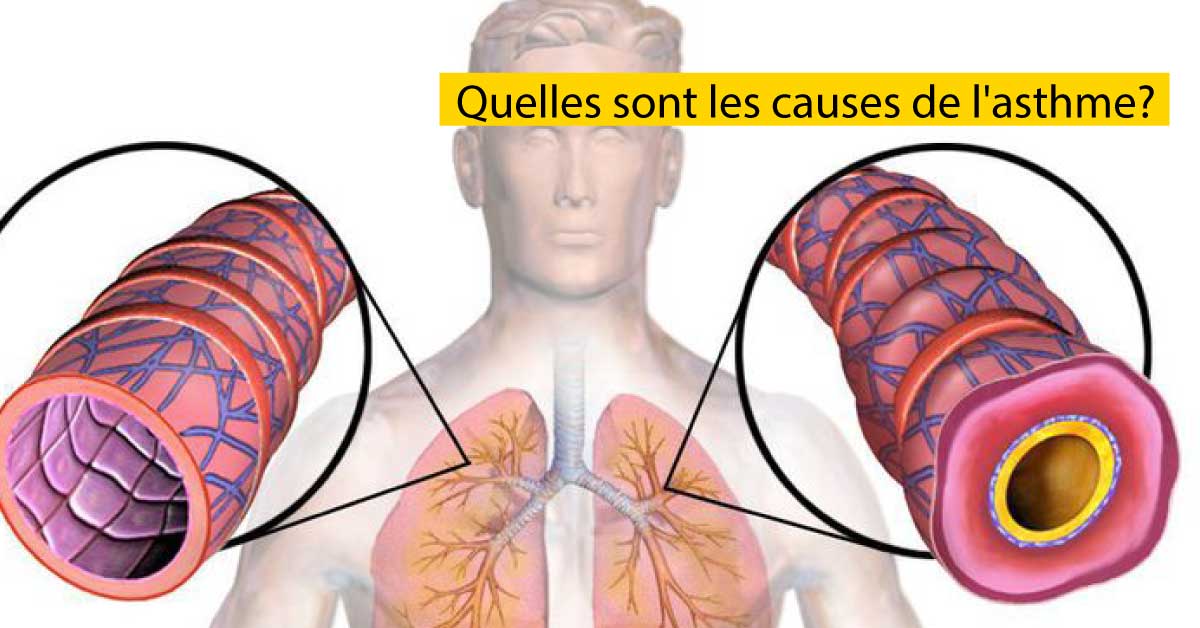 Quelles sont les causes de l'asthme?
