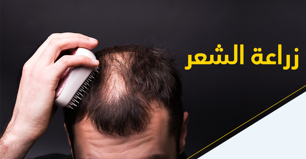 زراعة الشّعر