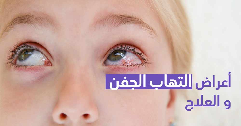 أعراض التهاب الجفن والعلاج