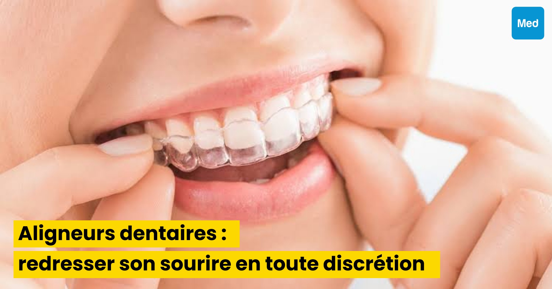 Aligneurs dentaires : redresser son sourire en toute discrétion