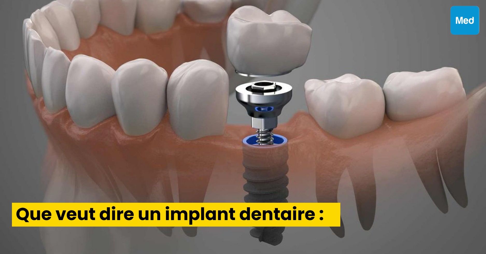 Que veut dire un implant dentaire