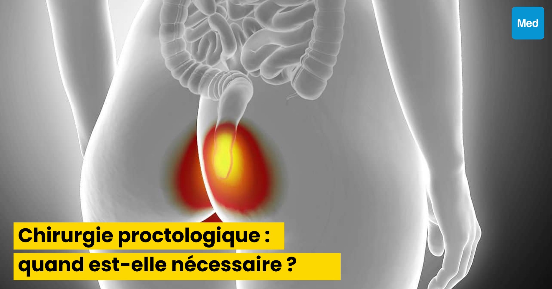 Chirurgie proctologique : quand est-elle nécessaire ?