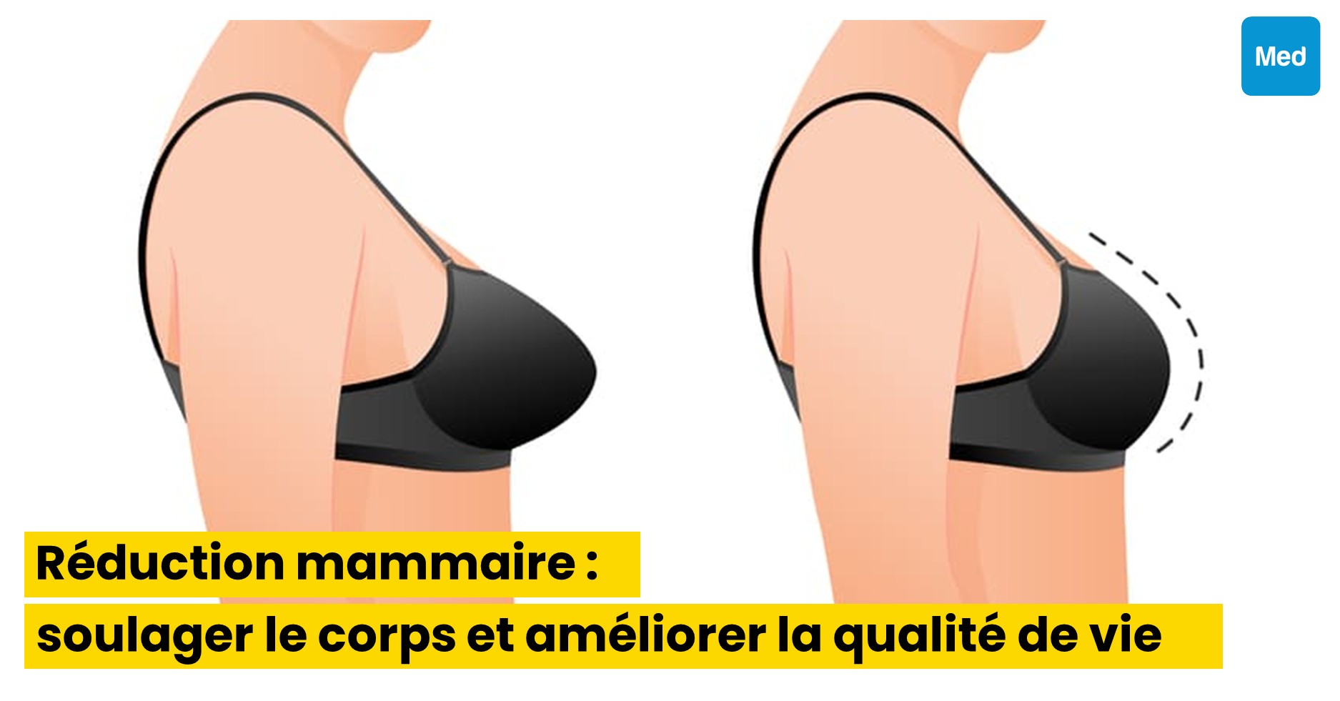 Réduction mammaire : soulager le corps et améliorer la qualité de vie