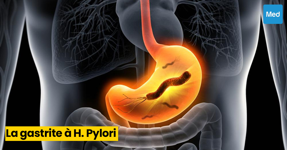 Comprendre la Gastrite à Helicobacter pylori : Causes, Symptômes et Traitement
