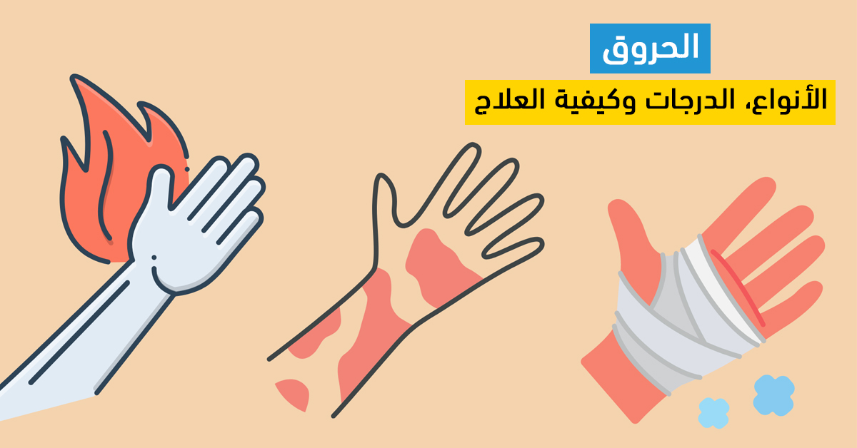 الحروق: الأنواع، الدرجات وكيفية العلاج