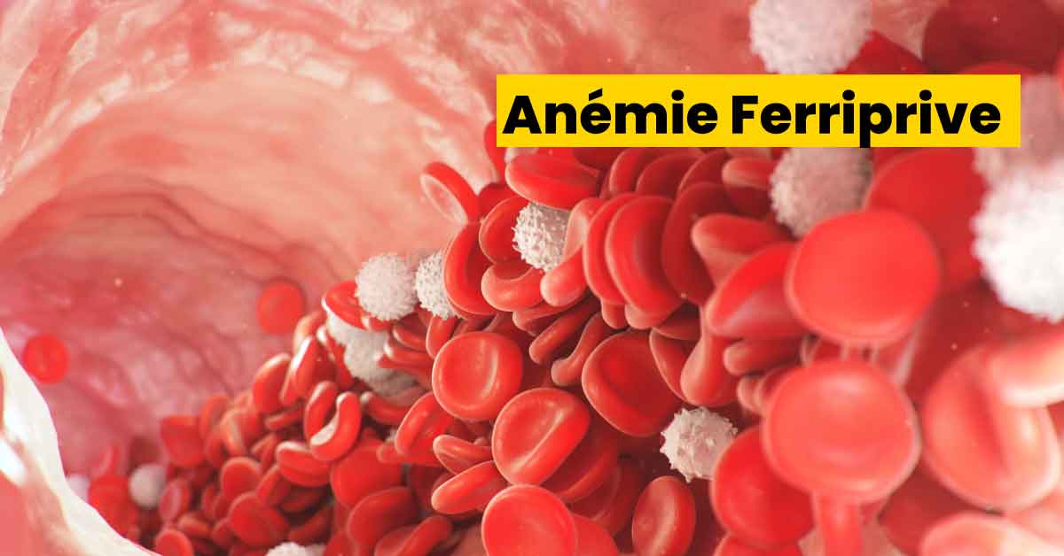 Anémie Ferriprive
