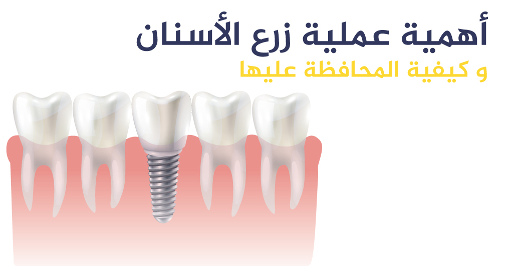 أهمية عملية زرع الأسنان و كيفية المحافظة عليها