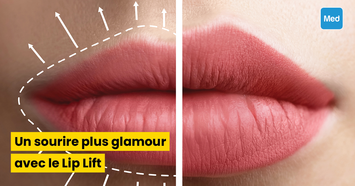 Un sourire plus glamour avec le Lip Lift
