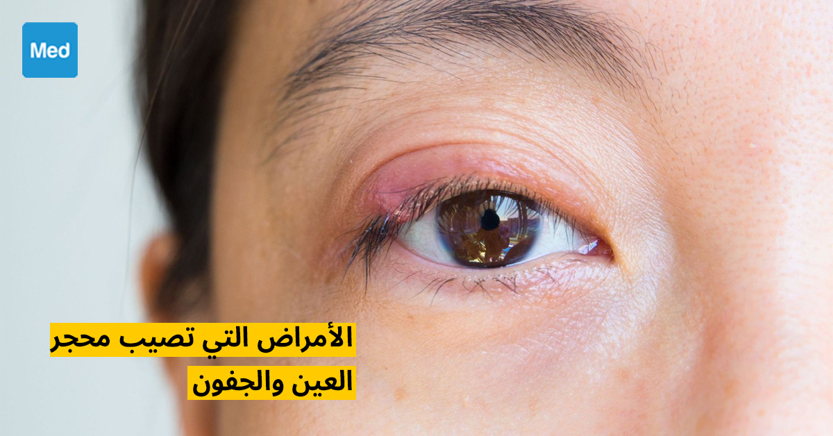 الأمراض التي تصيب محجر العين والجفون