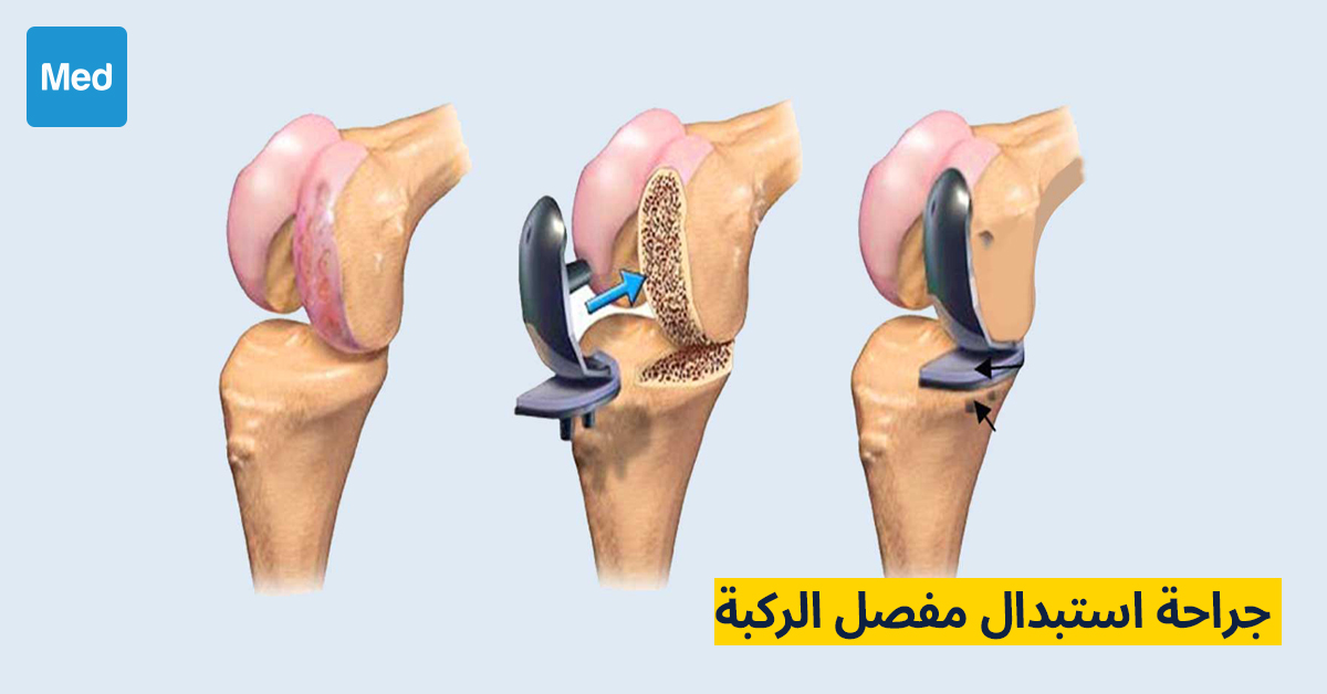 جراحة استبدال مفصل الركبة
