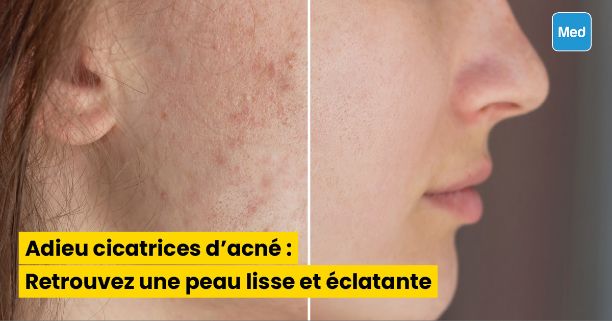 Adieu cicatrices d'acné : Retrouvez une peau lisse et éclatante
