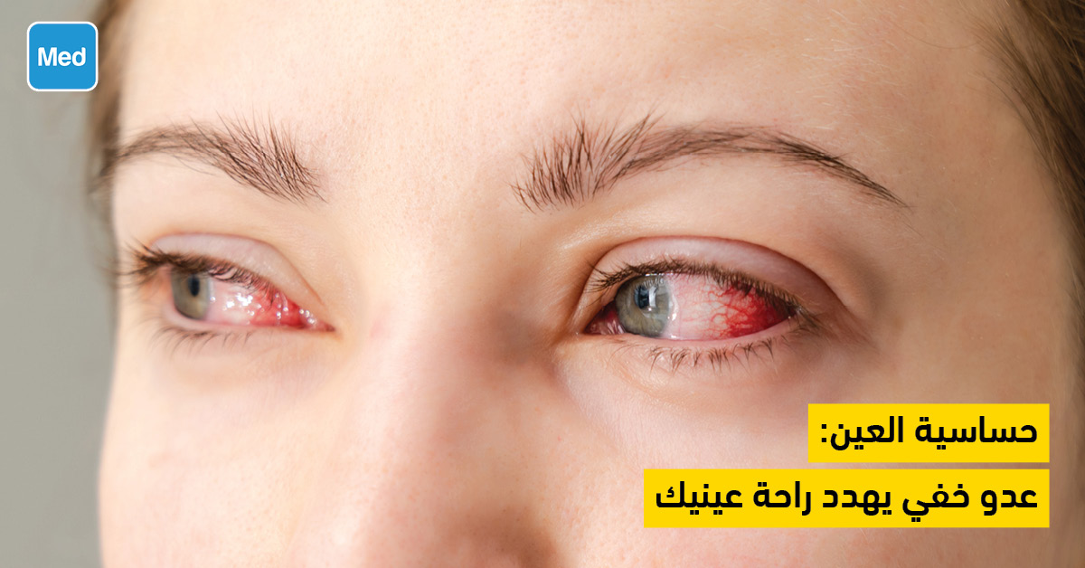 حساسية العين: عدو خفي يهدد راحة عينيك