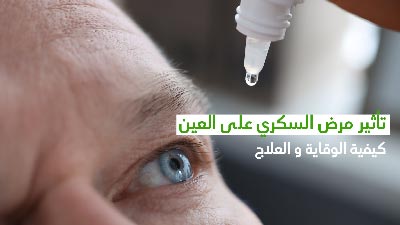 تأثير مرض السكّري على العين وكيفيّة الوقاية والعلاج