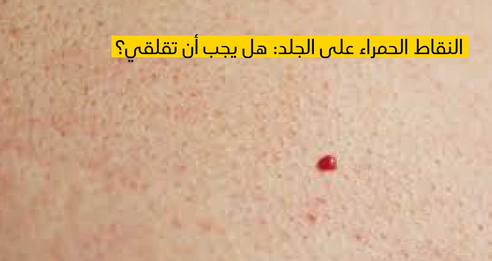 النقاط الحمراء على الجلد: هل يجب أن تقلقي؟