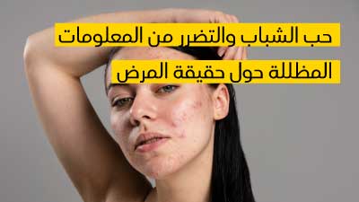 حب الشباب والتضرر من المعلومات المظللة حول حقيقة المرض