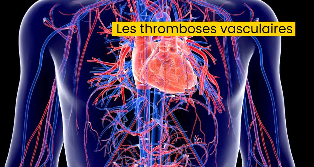 Les thromboses vasculaires