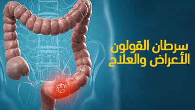 سرطان القولون : الأعراض والعلاج