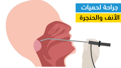 جراحة لحمات الأنف والحنجرة