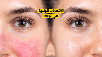 الالتهابات الجلدية في الوجه