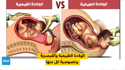 الولادة الطبيعية والقيصرية وخصوصية كل منها