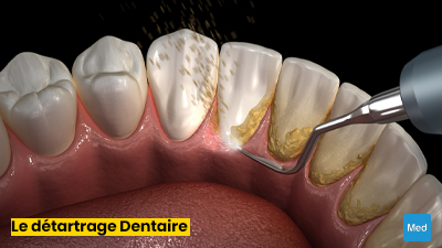Détartrage Dentaire : Le Secret d