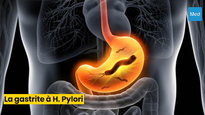 Comprendre la Gastrite à Helicobacter pylori : Causes, Symptômes et Traitement
