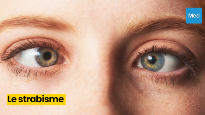Le strabisme : un trouble oculaire qui mérite d