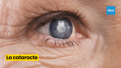 La cataracte : une maladie oculaire qui peut affecter la qualité de vie