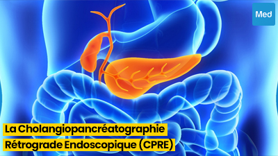 Tout ce que vous devez savoir sur la Cholangiopancréatographie Rétrograde Endoscopique (CPRE)