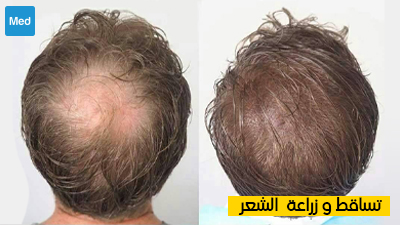 تساقط وزراعة الشعر