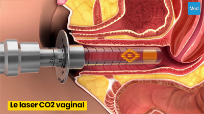 Le laser CO2 vaginal : une solution non invasive pour améliorer la santé et le bien-être intimes