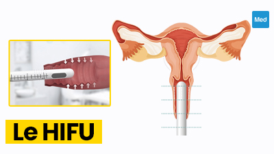 HIFU gynécologique : une nouvelle technique prometteuse