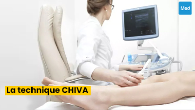La technique CHIVA : une alternative à la chirurgie des varices