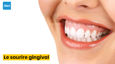 Le sourire gingival : définition, causes, diagnostic, traitement et prévention