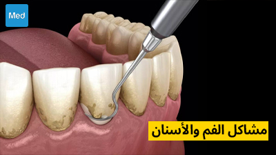 مشاكل الفم والأسنان 