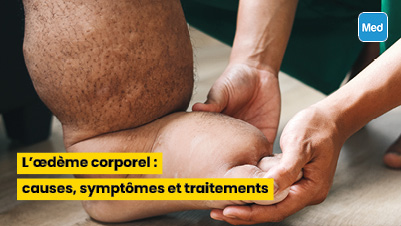  L’œdème corporel : causes, symptômes et traitements 