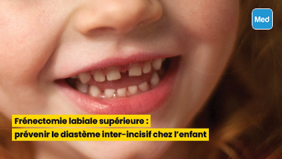 Frénectomie labiale supérieure  prévenir le diastème chez l