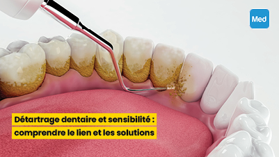 Détartrage dentaire et sensibilité : comprendre le lien et les solutions