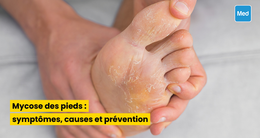 Mycose des pieds : symptômes, causes et prévention - Medical Magazine