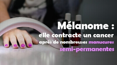 Mélanome : elle contracte un cancer après de nombreuses manucures semi-permanentes