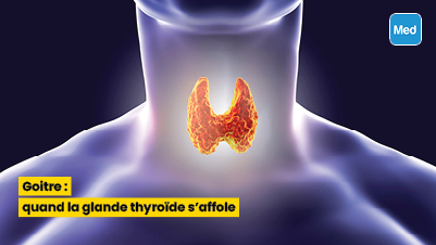 Goitre : quand la glande thyroïde s