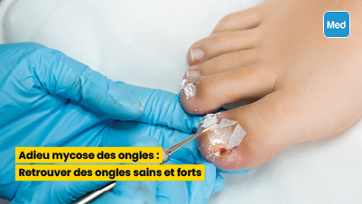 Adieu mycose des ongles : Retrouver des ongles sains et forts