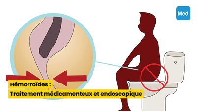 Hémorroïdes : Traitement médicamenteux et endoscopique