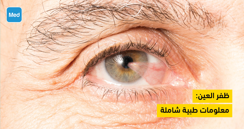 ظفر العين: معلومات طبية شاملة