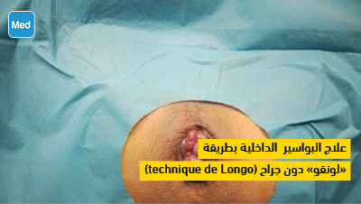  علاج البواسير الداخلية بطريقة (technique de Longo)