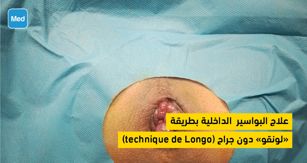  علاج البواسير الداخلية بطريقة (technique de Longo)