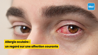 Allergie oculaire : un regard sur une affection courante