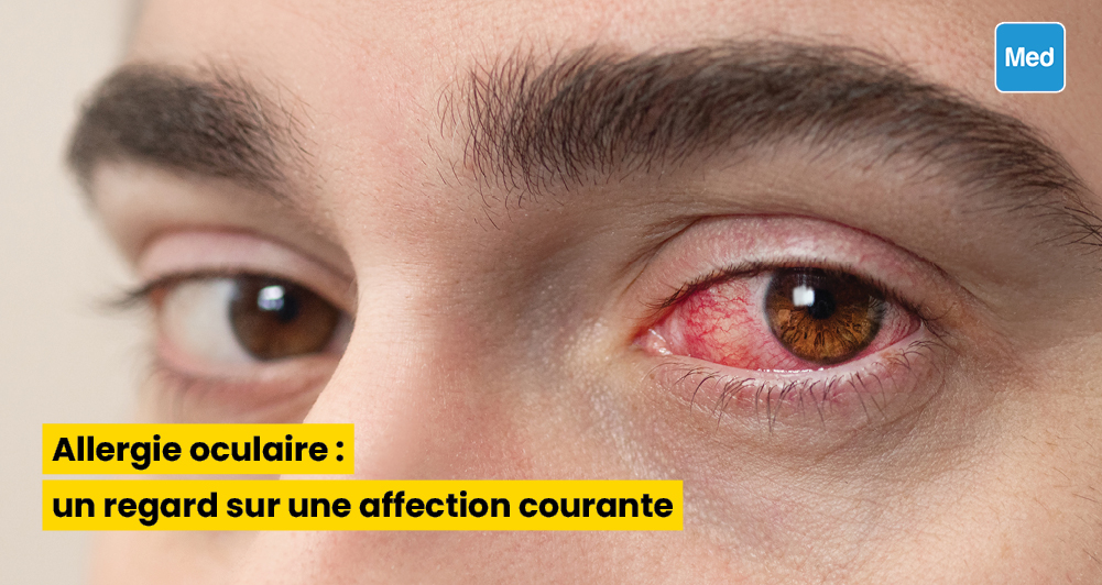 Allergie oculaire : un regard sur une affection courante