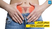 سرطان المبيض: الفهم، التشخيص والعلاج